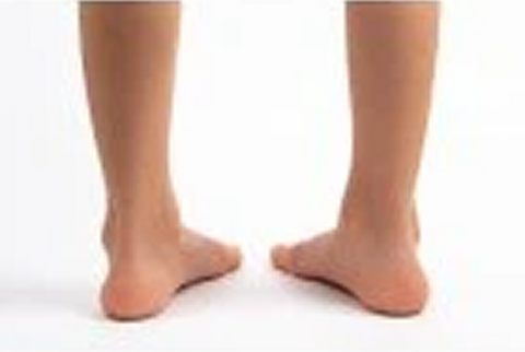 Intoeing, walking on tiptoe